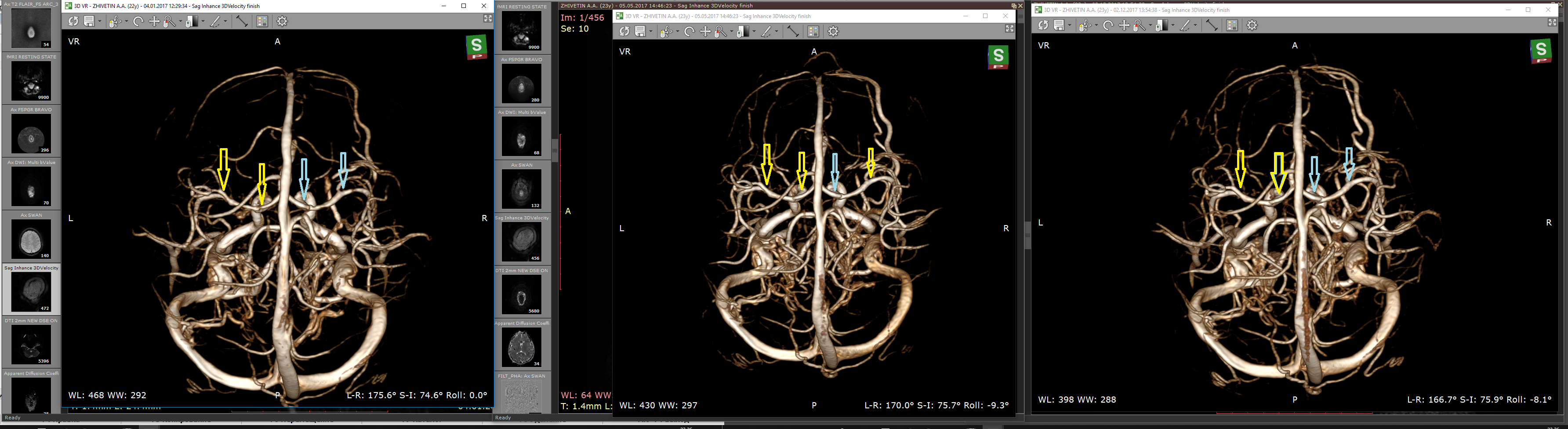 Динамическая картина MRT пациента с шизофренией