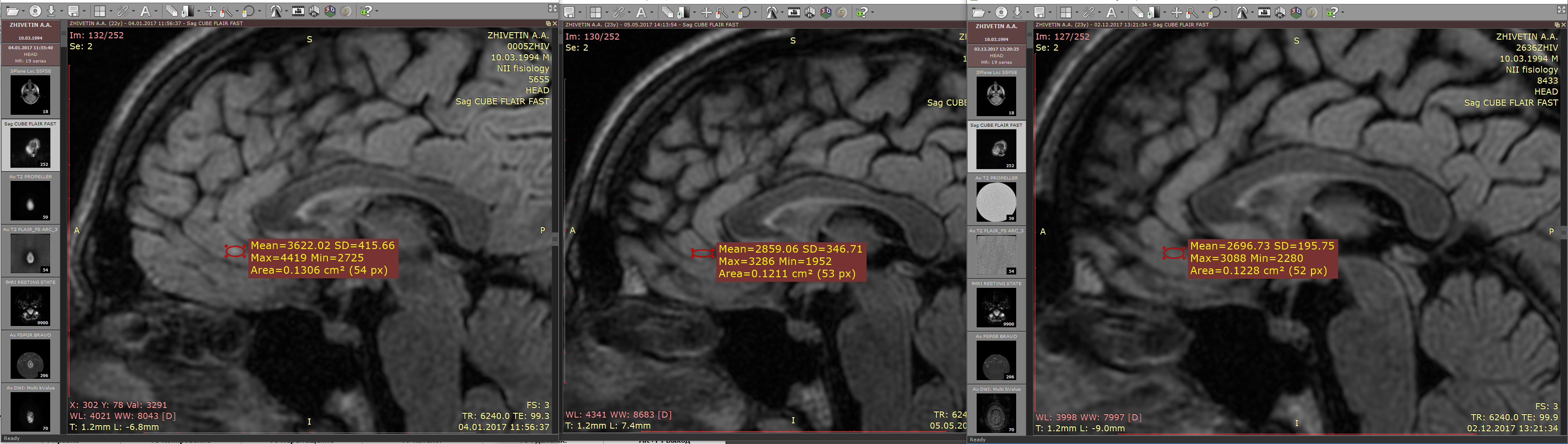 Динамическая картина MRT пациента с шизофренией